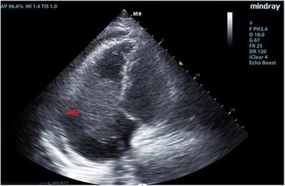 Case Report: A case of third-degree atrioventricular block associated with primary cardiac lymphoma